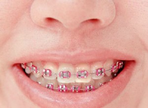 History of Dental Braces 